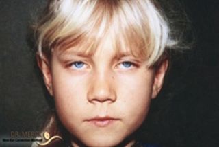 Ohren anlegen Bild nach OP 6